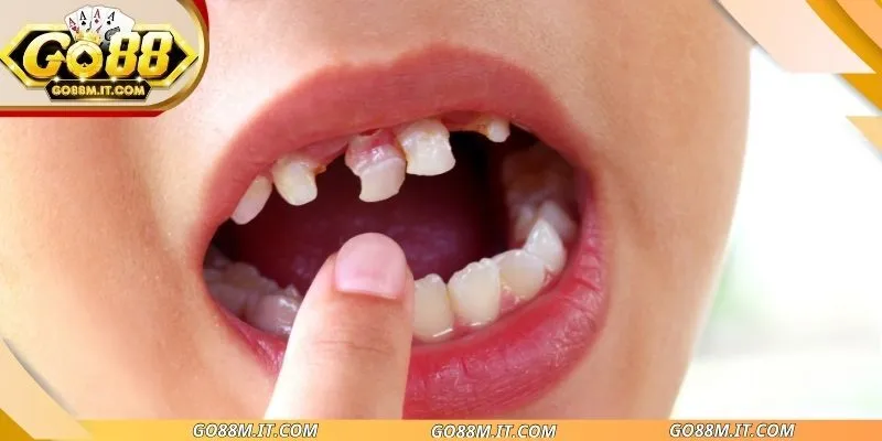 Nằm mơ thấy mất nhiều răng
